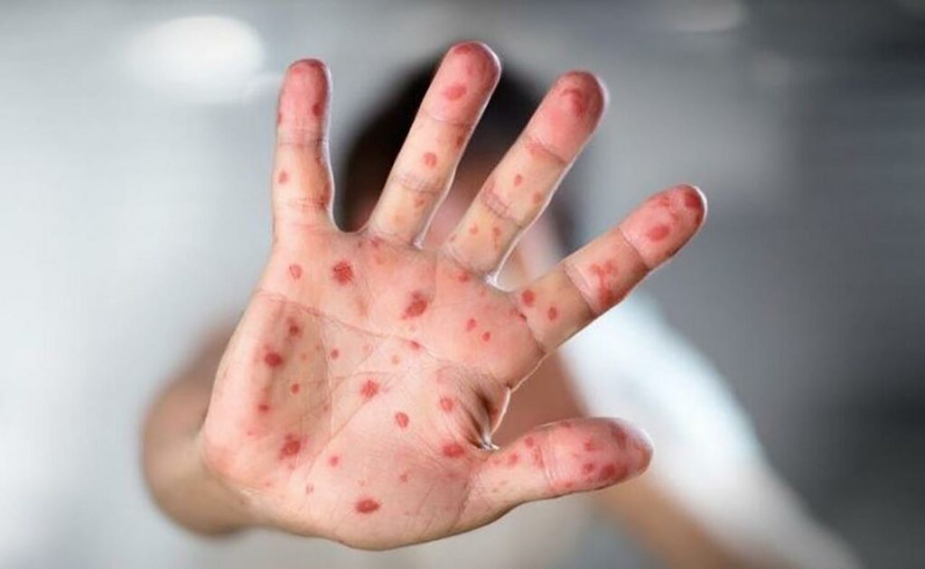 U FBiH raste broj djece zaražene morbilima, USK nema zabilježenih slučajeva