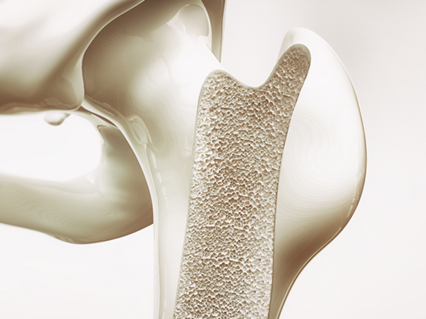 Osteoporoza viÅ¡e ne pogaÄa iskljuÄivo starije osobe, u riziku žene u periodu ulaska u menopauzu